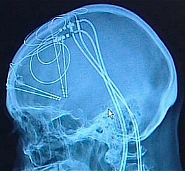 deep-brain-stimulation-fix
