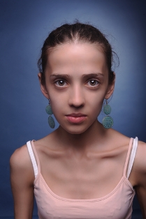 anorexic young girl