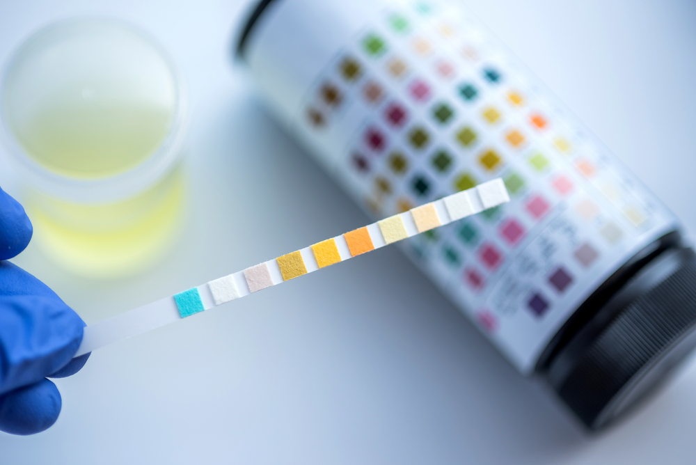 a hand holding a urinalysis testing strip