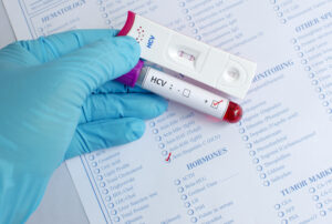 a gloved hand holding a positive hepatitis C vial.